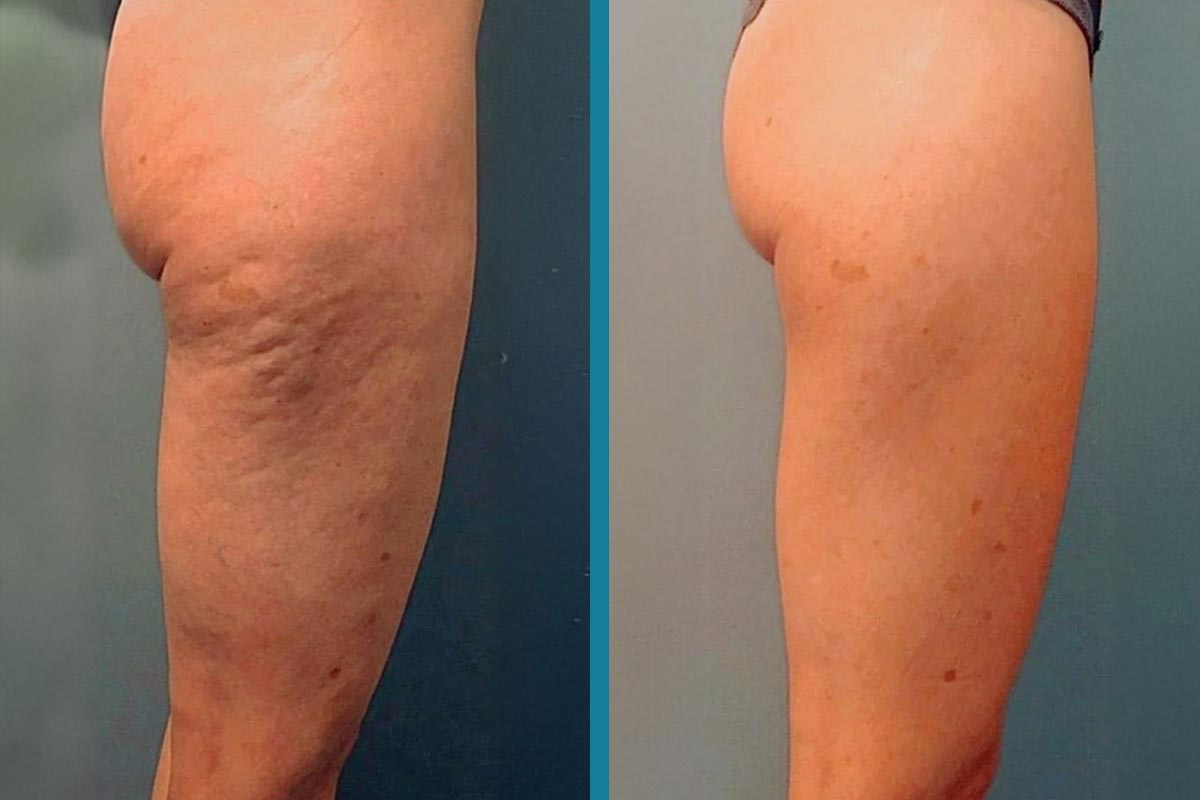 Silk Anti-Cellulite Oil with Collagen for Smoother, Firmer Skin