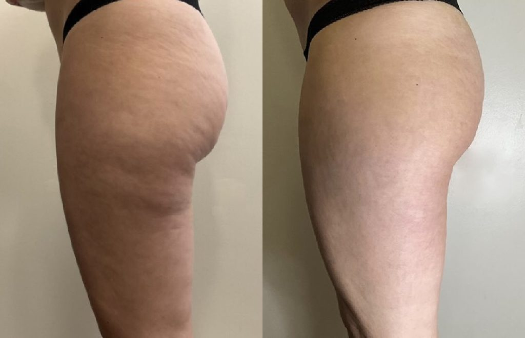 Silk Anti-Cellulite Oil with Collagen for Smoother, Firmer Skin